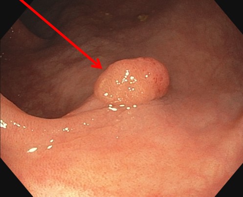 Un polype vu en coloscopie (Société Française d'Hépato-gastrologie)