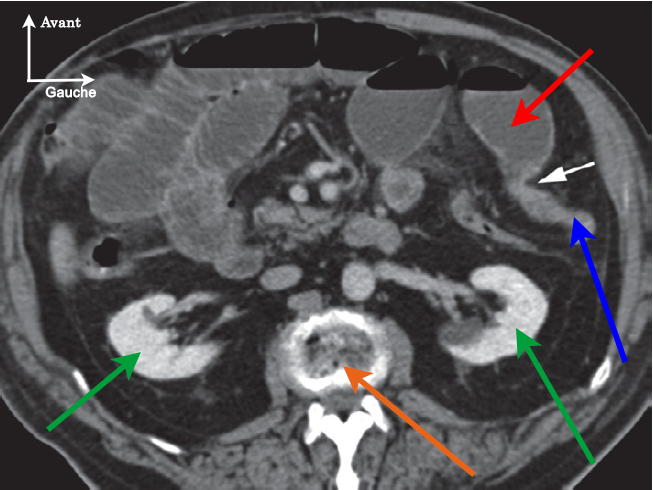 Scanner abdominal (TDM des urgences abdominales 3e édition, E. Delabrousse et P. Calame, éditions Elsevier Masson)