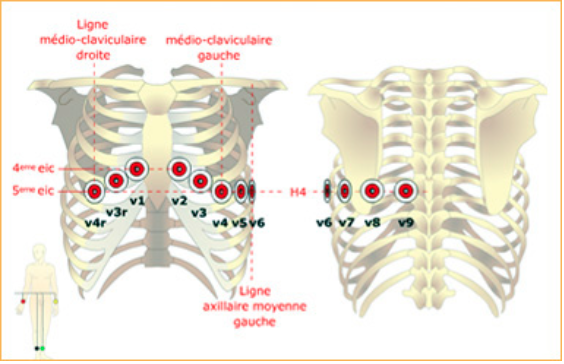 ECG 18 dérivations