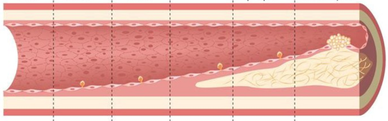 Étapes de l'athérosclérose