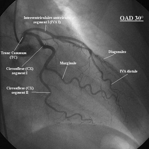 Coronarographie