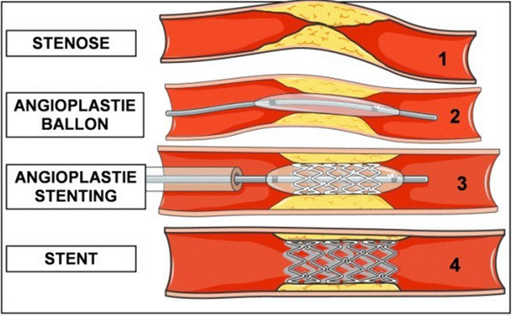 Angioplastie avec stenting