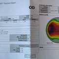 Lasik report 1