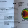 Lasik report 2