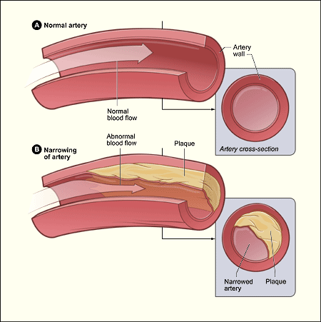 Illustration de l'athérosclérose (domaine public)